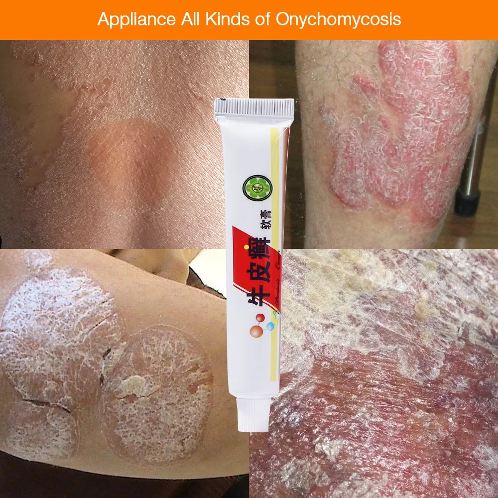 Крем Psoriasi Eczma идеально подходит для всех виды кожи устраняющих проблемы|Пластыри