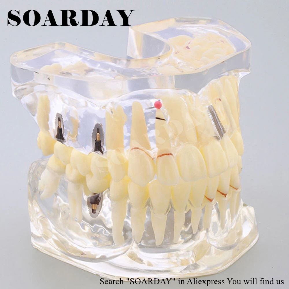 SOARDAY 1 piece 2 times Dental Pathological Model Implant Bridge Crown Treatment Oral Teaching Model SOARDAY 1 piece 2 times Dental Pathological Model Implant Bridge Crown Treatment Oral Teaching Model