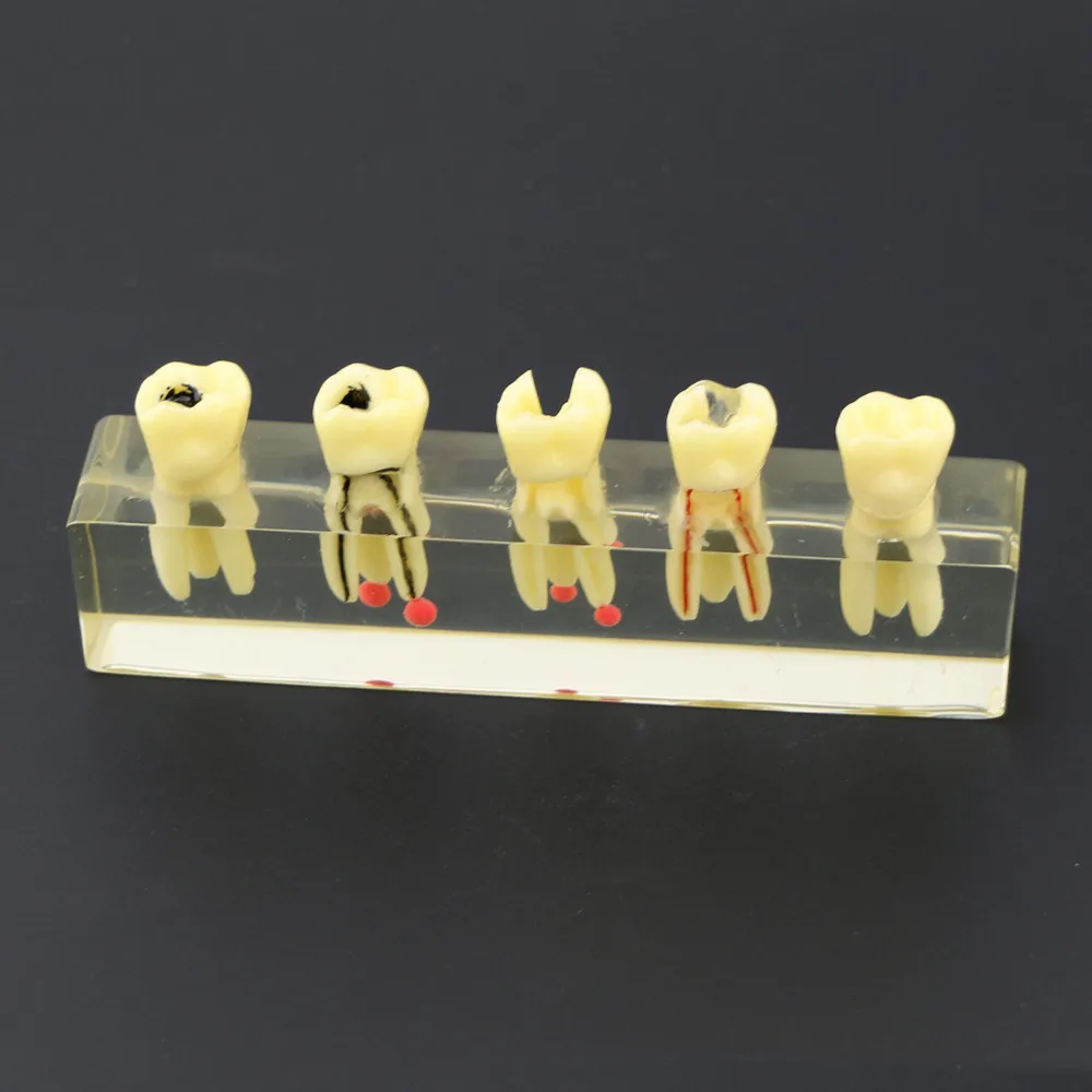 modelo de demonstração de tratamento endodontia modelo de estudo ensinar os dentes