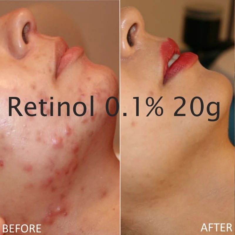 Us 3592 28 Offdarmowa Wysyłka Nowy Retinol Witamina A 01 Krem żel Retin Trądzik Przeciw Zmarszczkom Skazy Treatmen 20g W Kremy Na Noc Od Uroda I