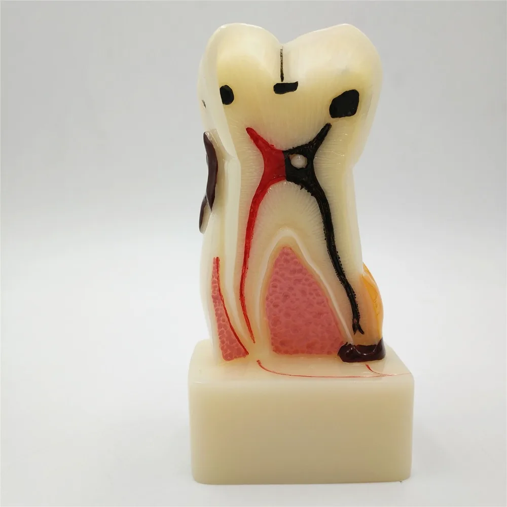 ALAN Dental Pediatric Tooth Model 4002 - Pathology Demonstration Study Teeth For Kids