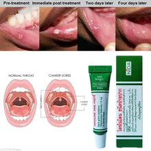 Creme antibacteriano oral erval natural do gel do alívio da úlcera da boca alívio rápido da dor severa & da irritação dentro de 2 minutos