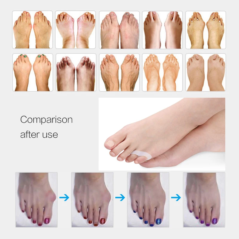 1Pair Pad On The Toe Little Thumb Silicone For Daily Use Toe Bunion Corrector Gel Guard Straightener Finger Toe Separator Foot