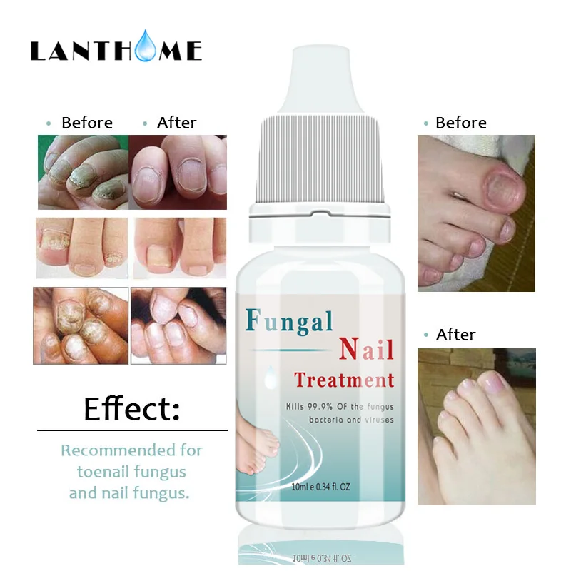 

Kills 99.9% Bacteria Nail Fungus Treatment Nail Care Oil Onychomycosis Paronychia Anti Fungal Nail Infection 10ml Repair Nails