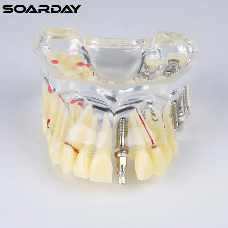 Implant-model-with-bridge-and-caries-5