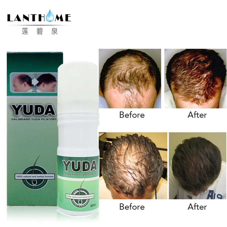 

Lanthome 3bottles bald hair Yuda pilatory extra strength Sunburst alopecia hair growth treatment stop hair loss products
