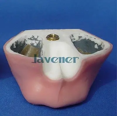 Dental Tooth Implant Practice Model Maxillary Model Teaching Model Simulation dental implant biomaterials