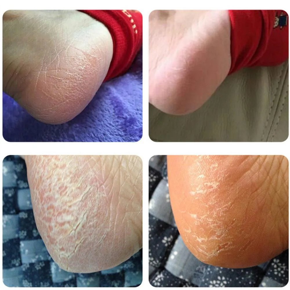

Feet Heel Skin Cracked Heel Balm Cream For Rough Dry & Cracked Chapped 9.4
