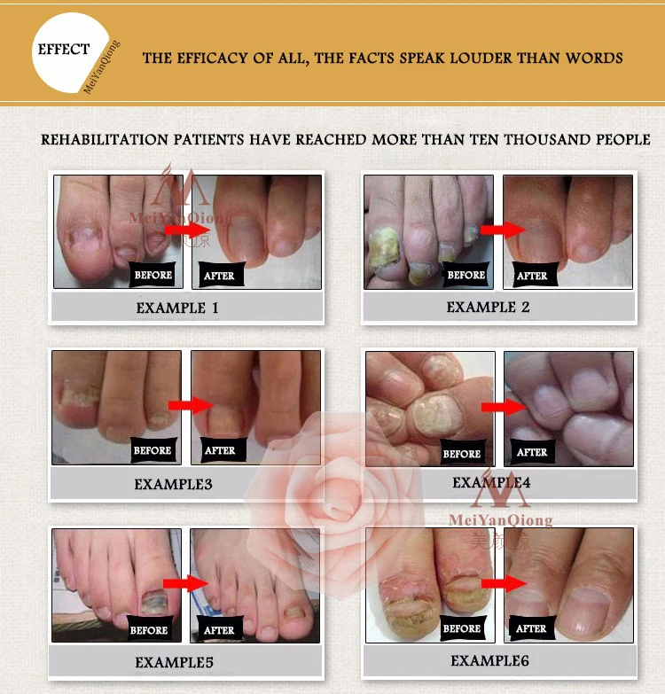 Fungal Nail Treatment Essence Nail and Foot Whitening Toe Nail Fungus Removal Feet Nail Care Essential oil