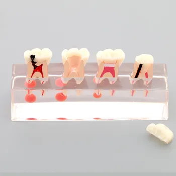 

Human Dental lab denture teeth anatomy 4-stage Endodontic Treatment Model Demonstration Teeth Model Teaching pathology Model