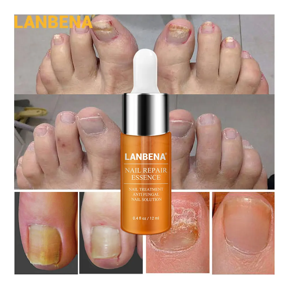 LANBENA Nail Repair Essence-Serum Fungal Nail Treatment Remove Onychomycosis Nose Tooth Nutrient Lightening Hand and Foot Care