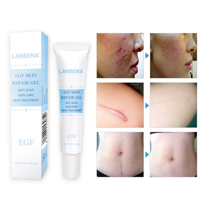 LANBENA Hyaluronic Acid EGF Anti Acne Against Black Dots Cream Scar Removal Facial BlackHead Repair Skin Care Treatment | Красота и