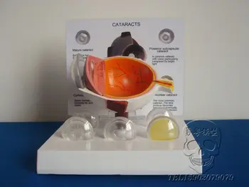 

Human eye lesion anatomy model cataracts enlarged eye model educational equipment