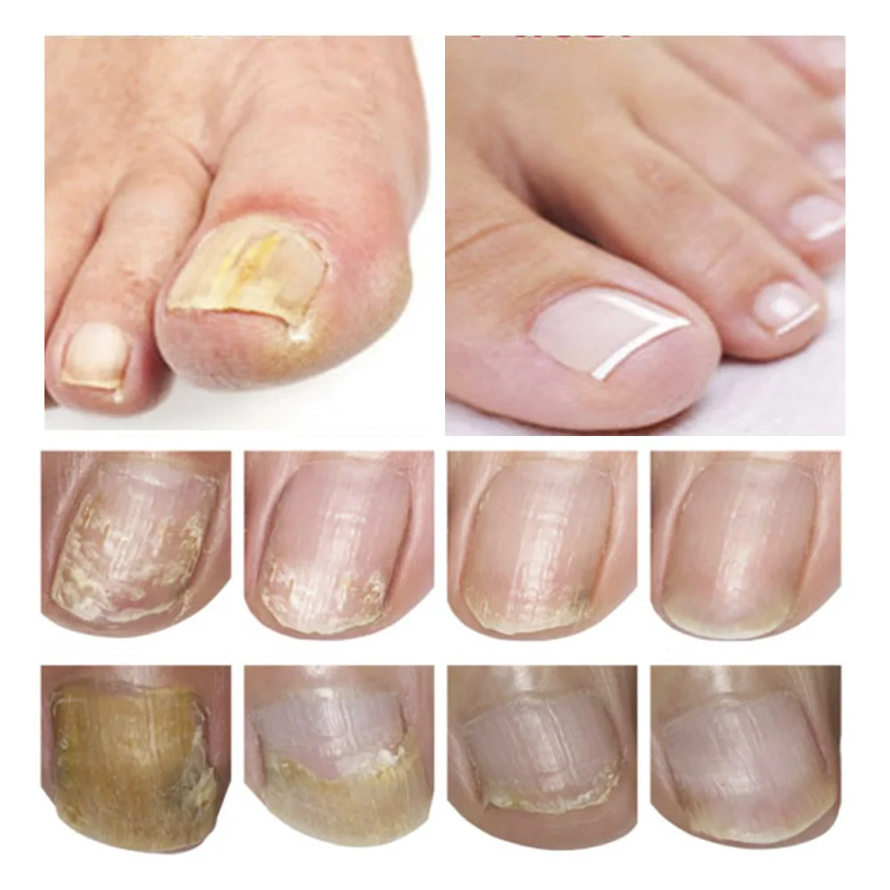 LANBENA ногтей ремонт сущность Сыворотки грибковых ногтей лечения удалить онихомикоз носком ногтей питательный Осветляющий Уход за руками и ногами