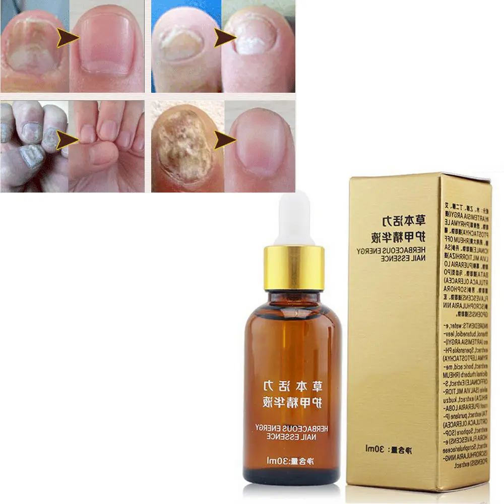 YANQINA Natural Toe Finger Nail Care Polish Oil Gel Anti Fungal