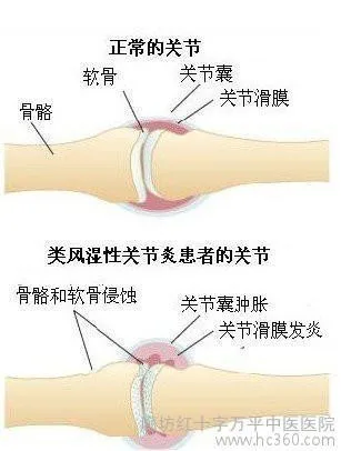 Борьба против ревматоидного артрита анкиллинга спондилита. Анти Ра и как