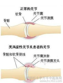 

Fighting against rheumatoid arthritis ankylosing spondylitis .anti RA and AS MEDICINE, 20 bags, each day twice
