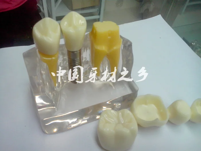 

Dental materials Planting nail Break up demonstration oral Four times Planting model transparent tooth free shipping