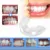 Equipamentos de Cuidados de Higiene Oral Dental Dente Dentes Ortodontia Appliance Instrutor de Alinhamento Para Adultos Aparelhos Para Os Dentes