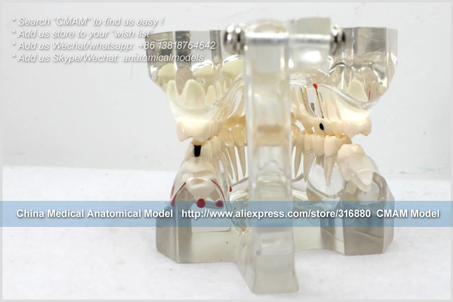 CMAM/12594 Dental-патологическая Стоматологическая модель, 2X в натуральную величину, полости рта человека стоматологический медицинский анатомическая модель