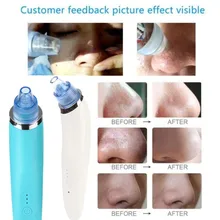 Угрей пылесос Comedo всасывание удаление шрамов акне пилинг для пор лица Чистая уход за кожей красота машина