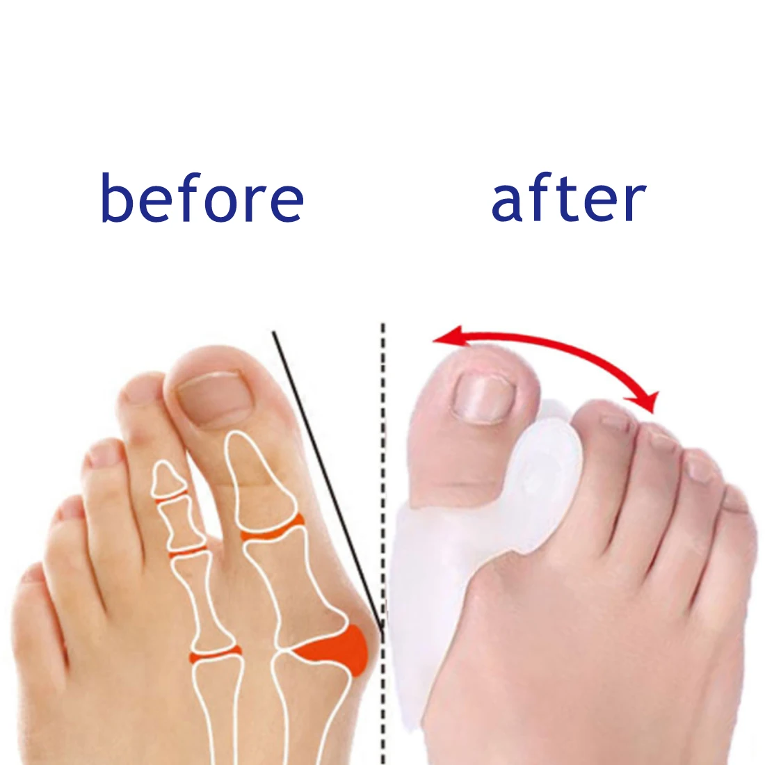 Как выпрямить большой палец на ноге. От косточки на большом пальце. При вальгусе выпрямитель для большого пальца стопы. Как выпрямить большой палец на ноге. Как выпрямить большой палец на ноге.