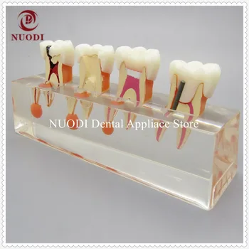 

Dental Clinic Deciduous Endodontic treatment model/Dentist Use Endodontic treatment teeth model/Dentistry Communication Model