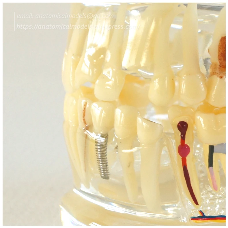 13066 Half Pathology Model 1 