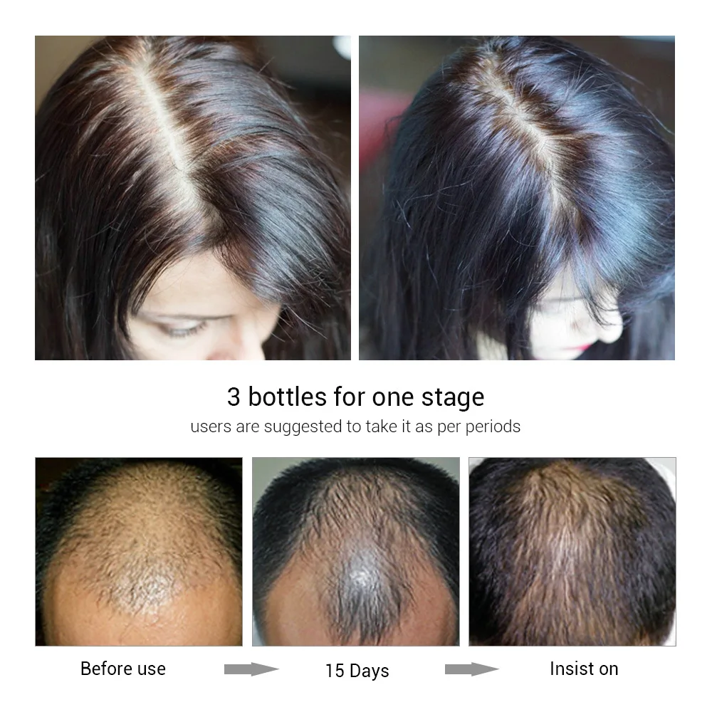 Okeny's Уход за волосами эссенция роста лечение выпадения волос спрей роста 1 шт