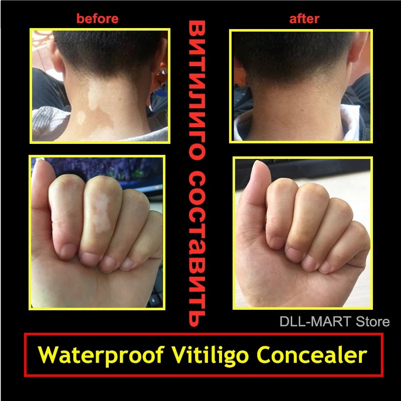 Водонепроницаемая маскирующая ручка Leukoderma Vitiligo жидкая эссенция растений для