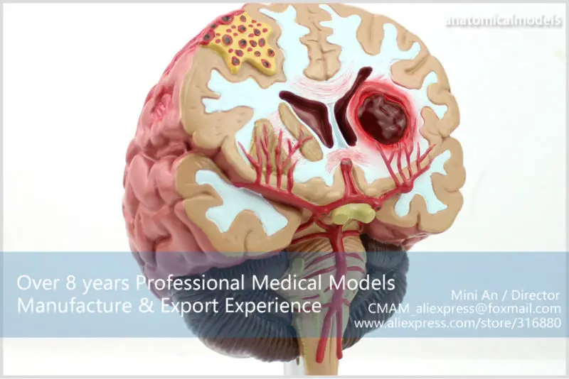 CMAM-BRAIN10 Медицинский Анатомический Мозг Модель Болезни, анатомические Модели Мозговой Артерии Порок