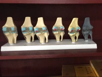 

Knee joint pathology model articular osteopathy morbidity display human knee joint disease model teaching model