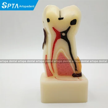 

4:1 Dentist Dental Study Teach Tooth Model Teeth Disease Model