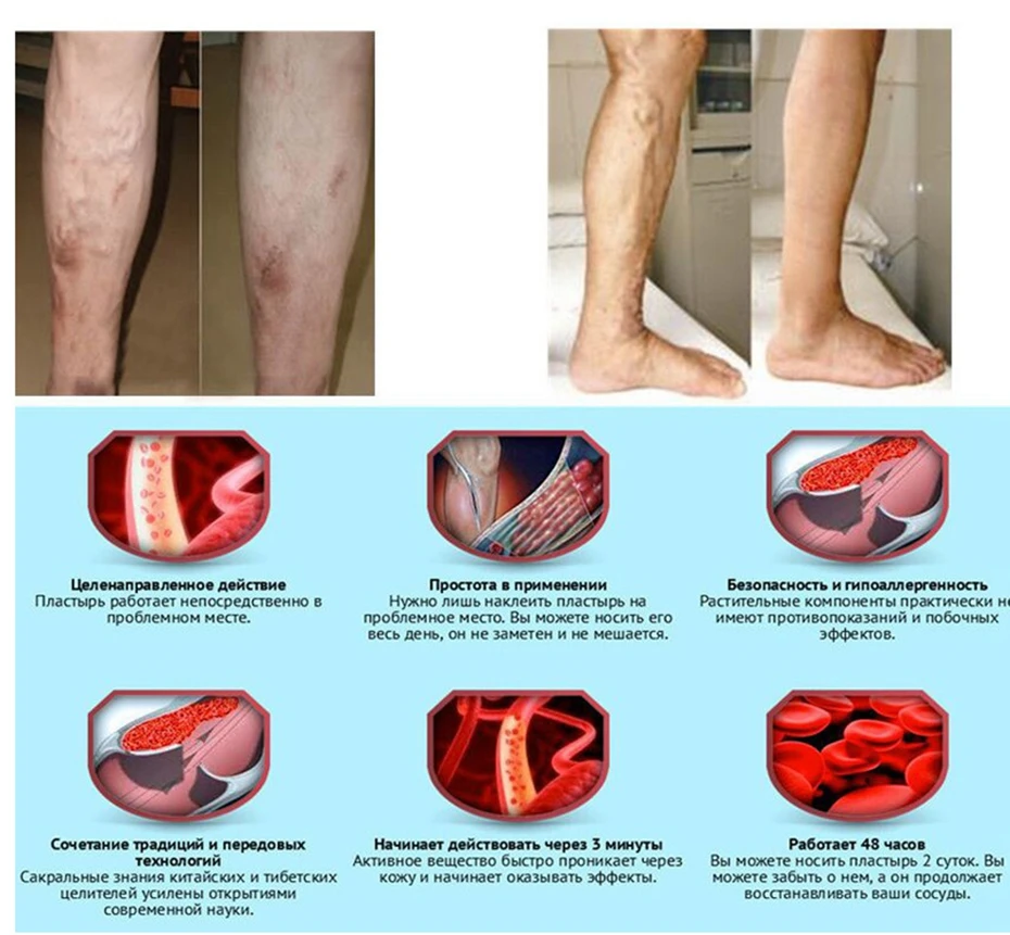Без коробки! Китайская натуральная травяная медицина для лечения варикозного сосудистого воспаления массажный крем для лечения варикозного расширения вен мазь