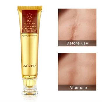 

face cream whitening skin care anti acne treatment cream oil control Moisturizing Acne Scar Remover Pores acne cream