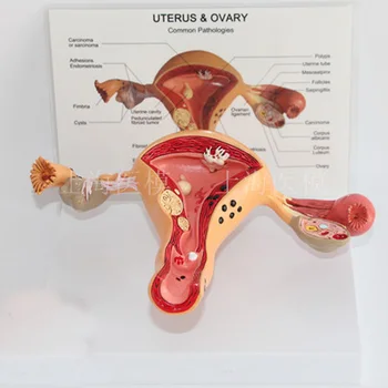 

UTERUS &OVARY common pathologies Uterine Disease Ovarian disease Ovarian anatomical model Obstetrics and Gynecology