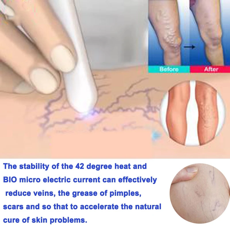 Jual 1 Pcs Medis Cahaya Biru Terapi Varises Perawatan Laser Pena Lembut Scar Kerut Penghapusan Pengobatan Dropshipping