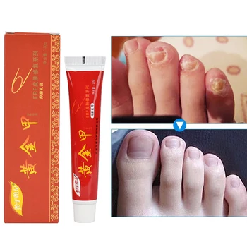

20G Fungus Treatment for Nail Treatment Ointment Toenail Onychomycosis Fights Bacteria And Fungus Naturally