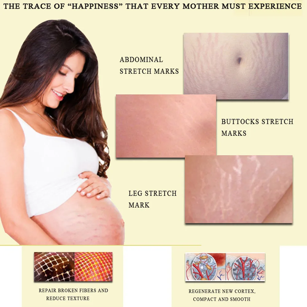 Растягивающийся крем для эфирного удаления, крем для восстановления шрамов при беременности, крем для удаления живота, крем для восстановления шрамов при беременности