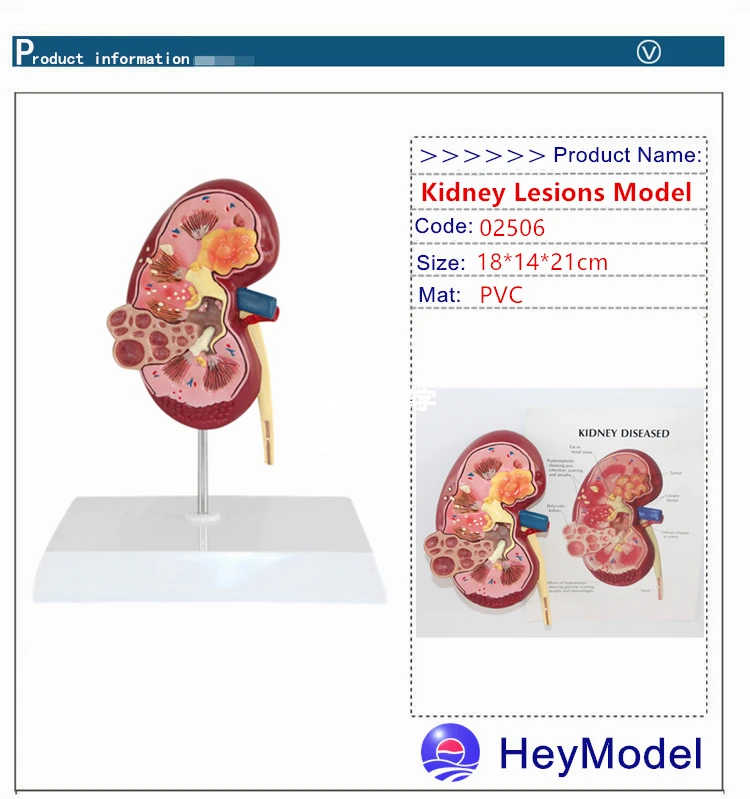 Heymodel почек поражений модель