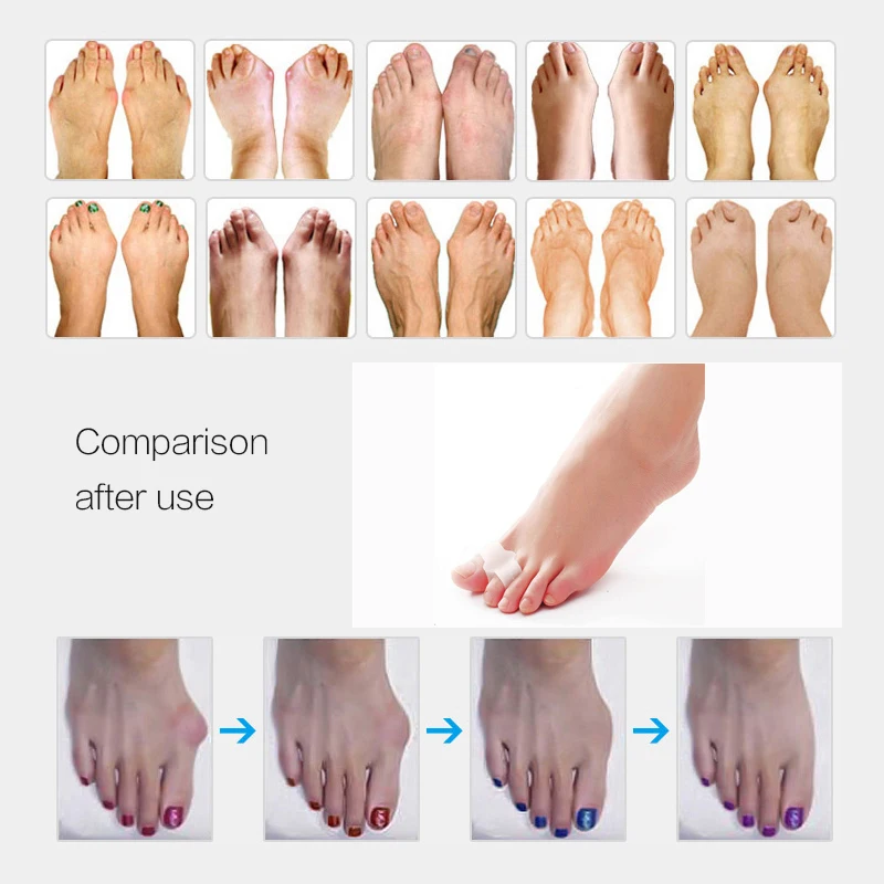 6Pair Hallux Valgus Pro Corrector Big Toe Concealer Thumb Silicone Toe Separator Finger Protector Remove Calluses Pedicure Tools