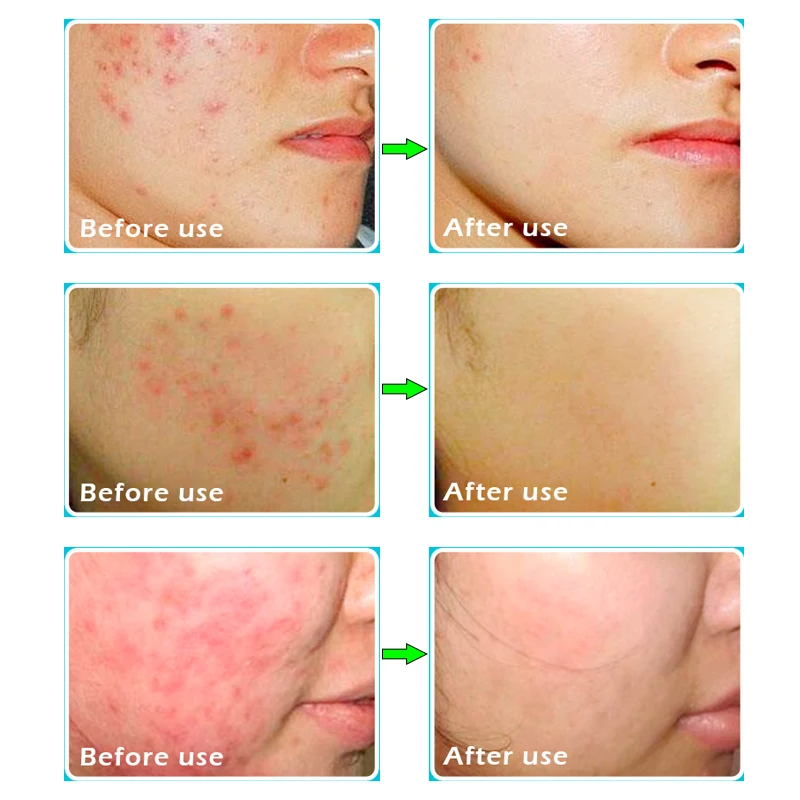 Крем для ухода за кожей лица от акне 20 г|skin care|acne treatmentanti acne |