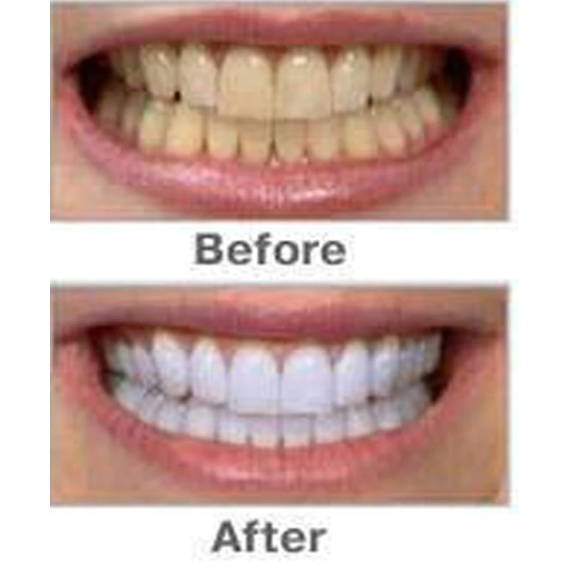 Teeth Whitening Singapore Promotion-Shop for Promotional 