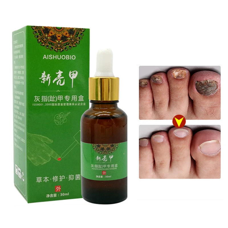 

Nail Treatment Remove Onychomycosis Fungicide Nail Regeneration Repair Nail Nourishment Protection Toe Paronychia Anti Fungus