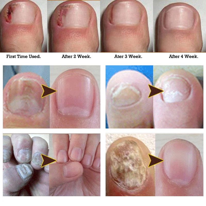 Против грибковой инфекции ногтей Лечение грибка для ногтей мазь Лечение ногтей onychomicosis Paronychia Новинка