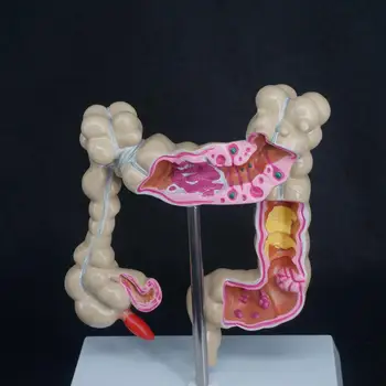

Human Colon large Intestine Pathological Diseases Model Organ Anatomy Teaching Resources