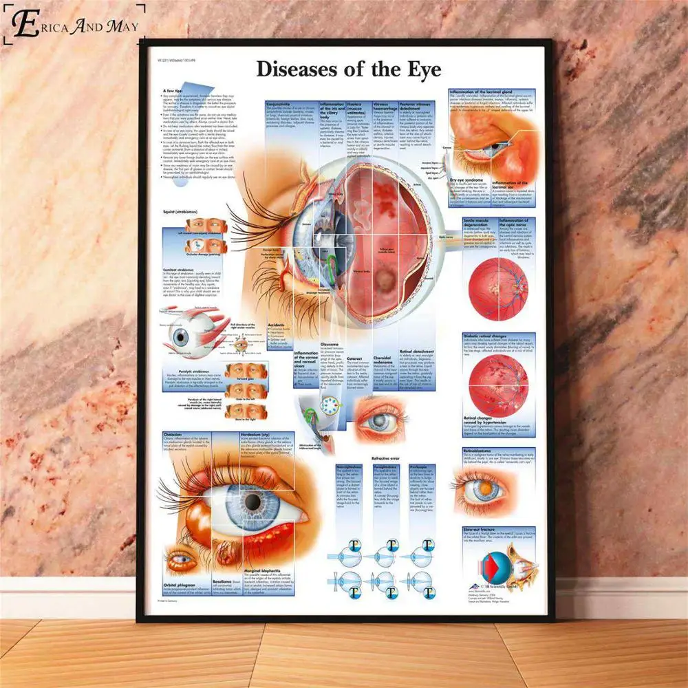 Анатомия болезни патологии диаграмма картина, печатный плакат декоративные настенные картины для комнаты без рамки украшения дома аксессуары - Цвет: Diseases Of The Eye