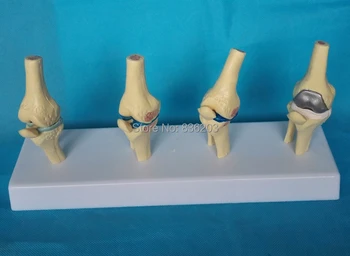 

4 stage Anatomical Human Degenerative Knee Joint Disease Skeleton Anatomy skull anatomical brain in trauma esqueleto anatomia