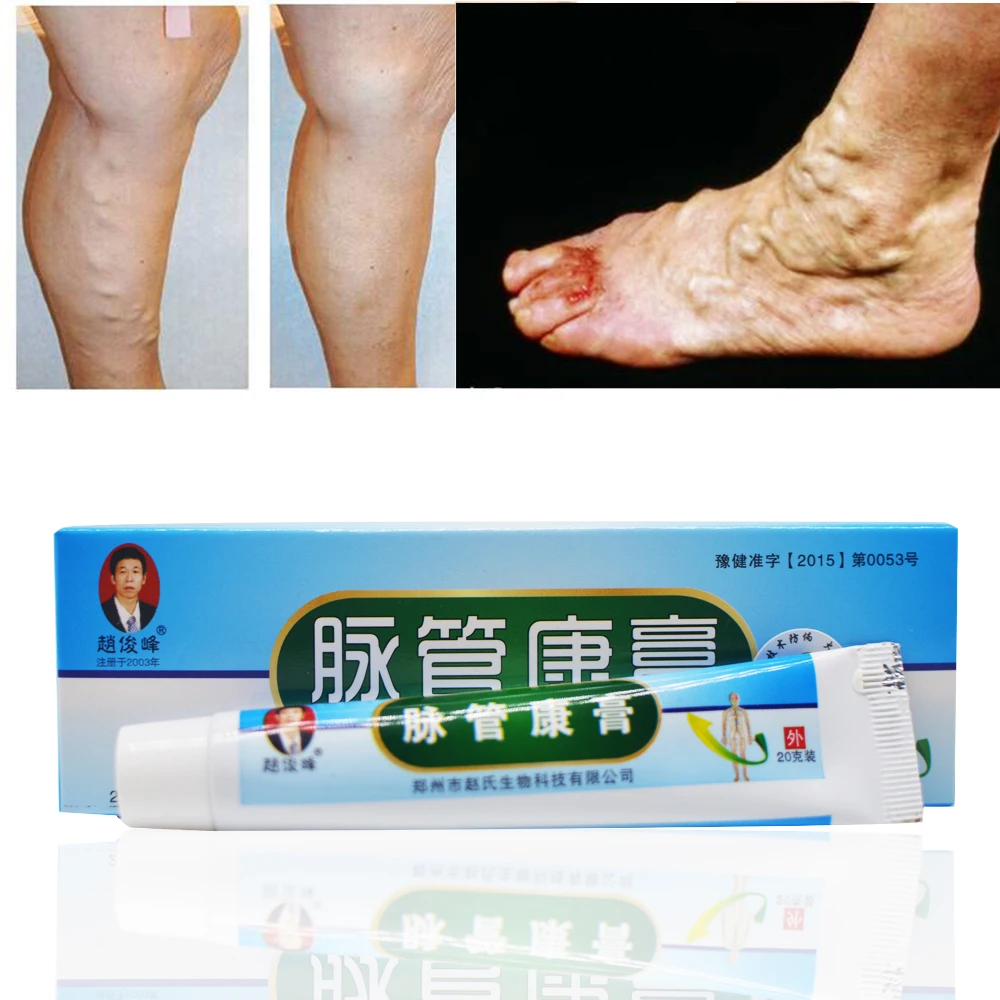 How to treat inflammation and varicose veins How to treat inflammation and varicose veins