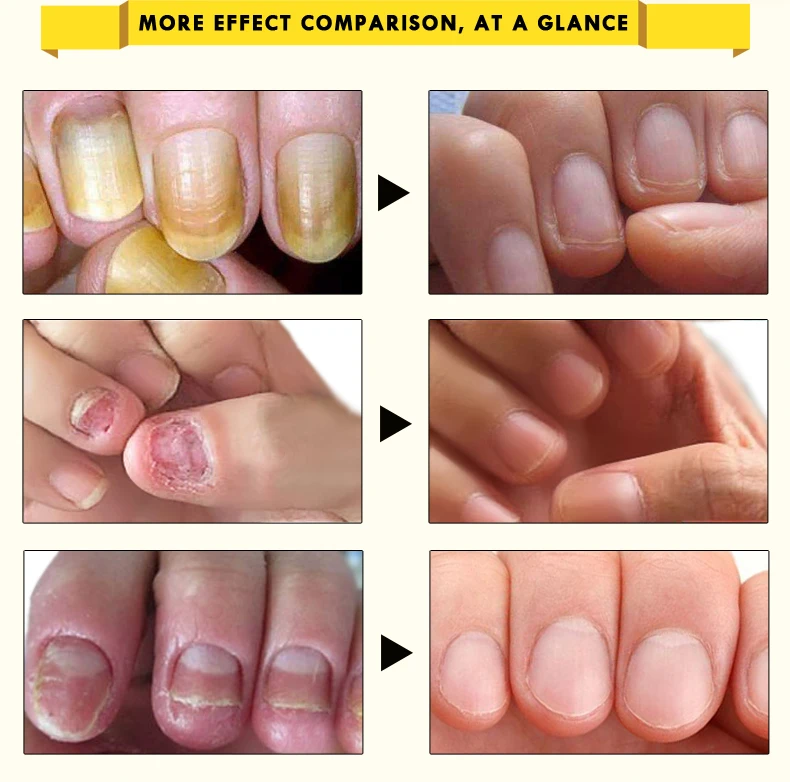 Травяные антибактериальные средства для лечения ногтей эфирное масло травяной экстракт грибок для ногтей Инструменты для ремонта Уход за ногтями на ногах улучшение инфекции